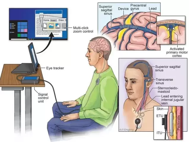 Cấy Chip Vào Người: Thông Tin Và Ứng Dụng cay-chip